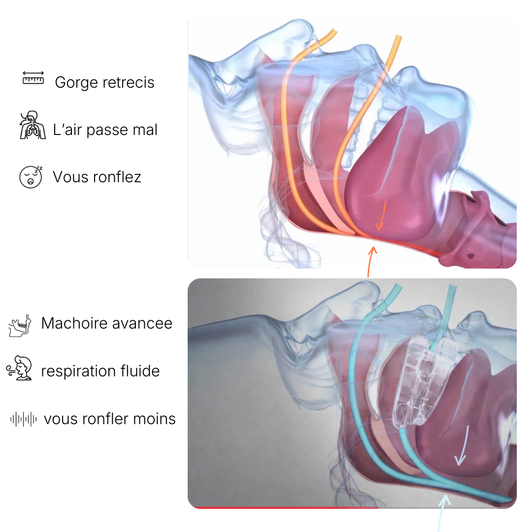 Schéma médical comparatif - gorge rétrécie qui cause le ronflement et apnée du smmeil vs mâchoire avancée avec orthèse mandibulaire CalmNox pour une respiration fluide et moins de ronflements